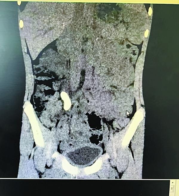 8岁娃腰腹疼痛以为是肠胃炎，一查竟是肾结石！