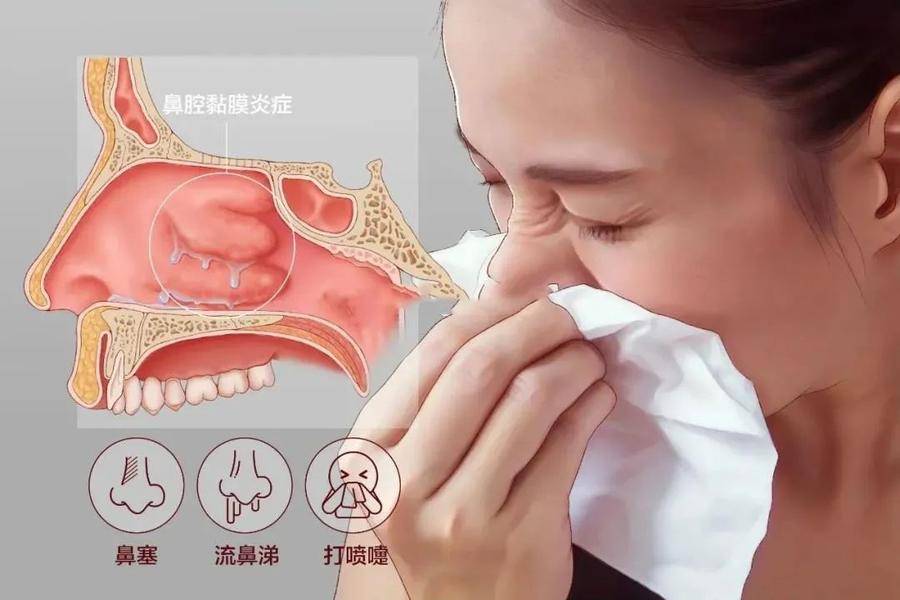 急性鼻炎是感冒吗？得急性鼻炎应该怎么办？