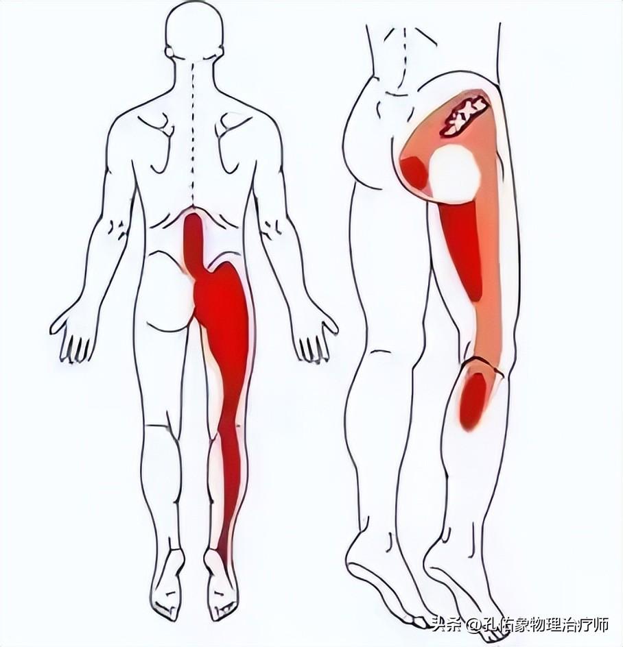 为啥臀部、小腿后外侧酸胀痛、麻木？该如何应对？一文详细告知您