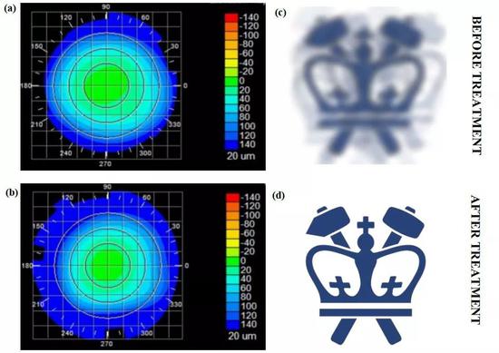 接受治疗前后的角膜形态（左），以及模拟的视觉效果变化（右）