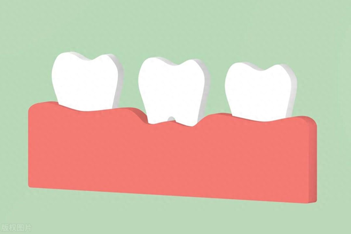 健康早知道：如何治疗牙周病？